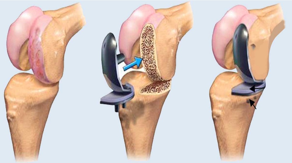 Arthroplasty Solutions for a Pain-Free Life