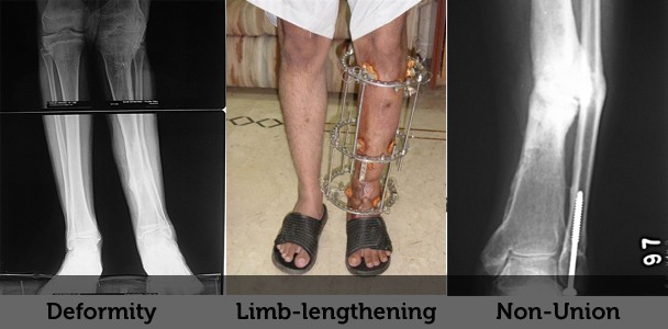 Ilizarov Method for Limb Lengthening