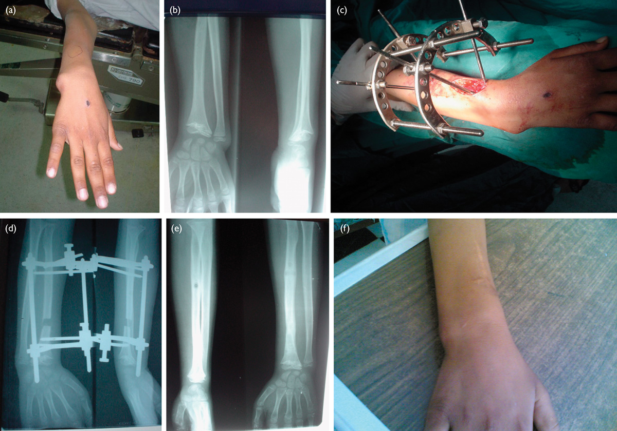 Orthopedic and Deformity Correction